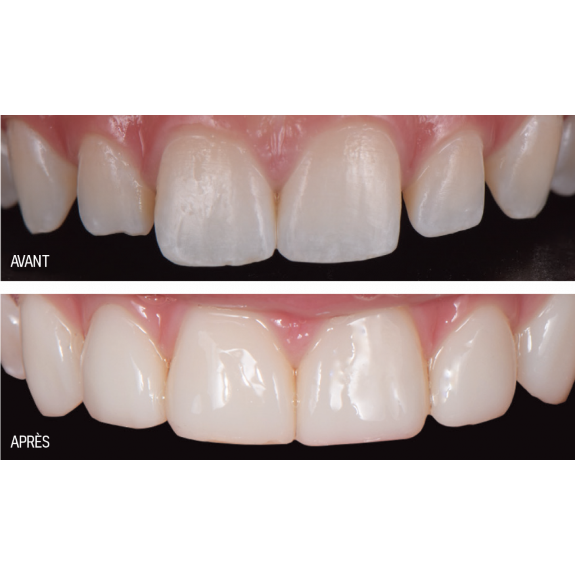 Kit intro Luna 2 - composite universel - 5 seringues 4 g - SDI