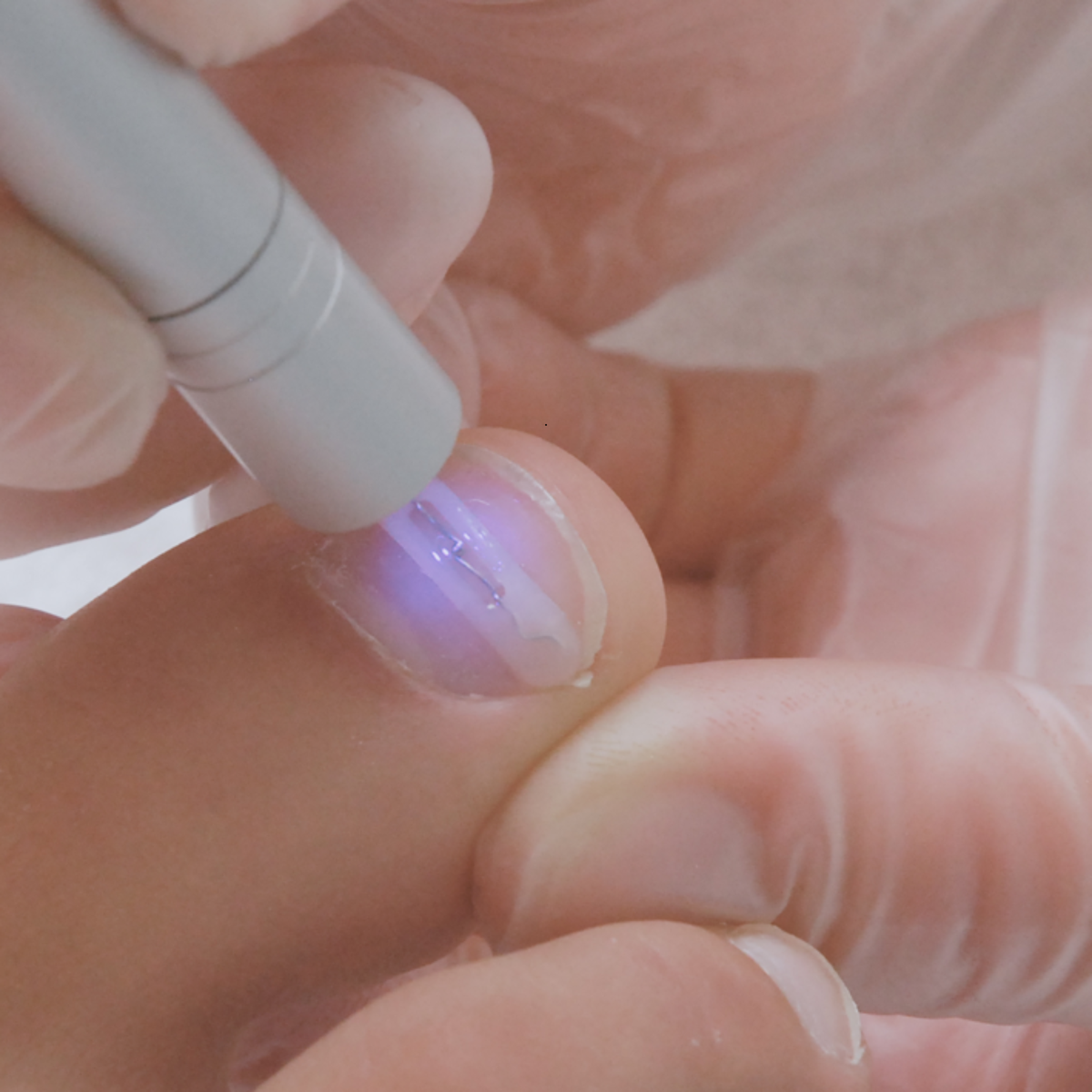 Micro lampe pour gel de scellement UV PediGel - Podofix - My Médical